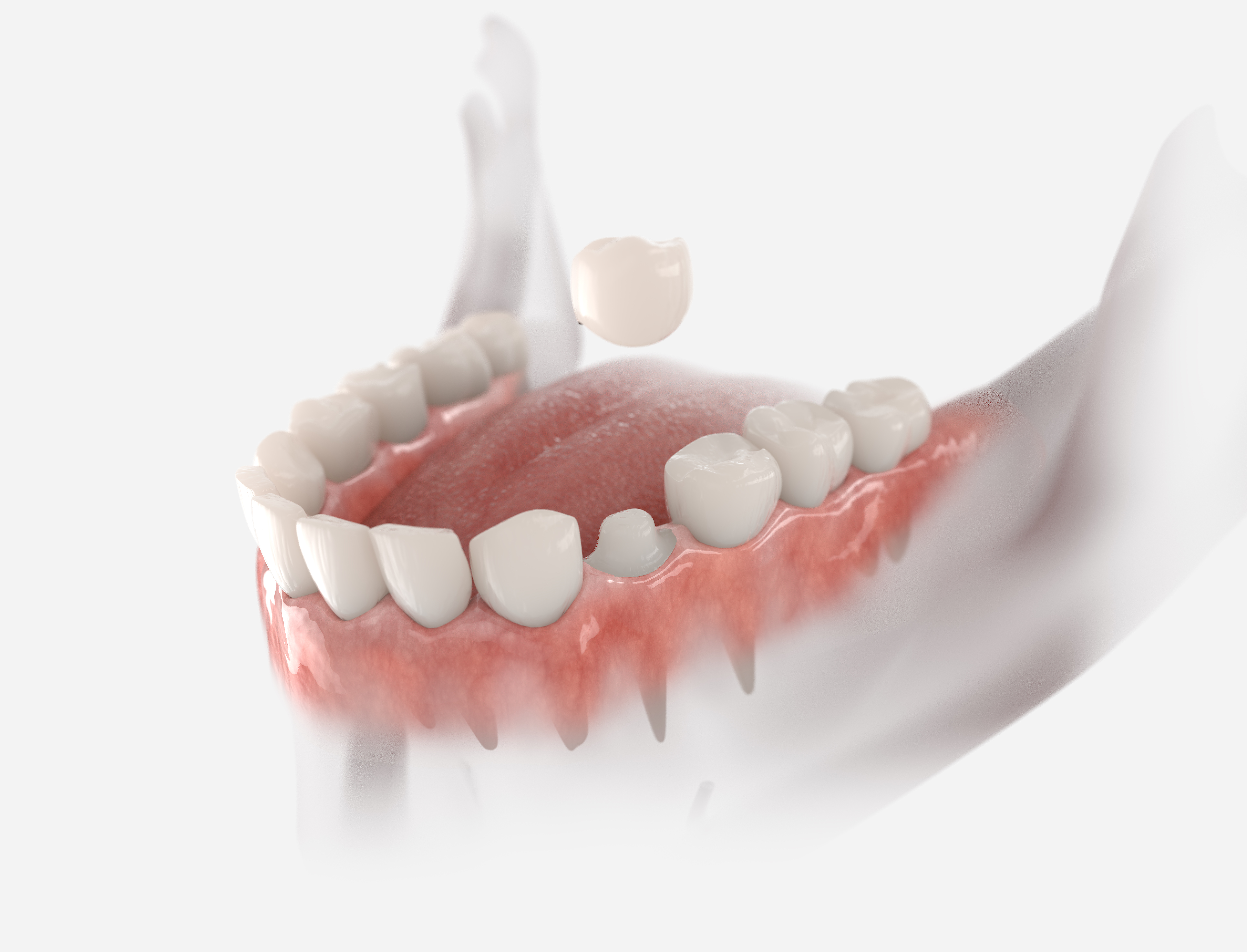 Dental crown