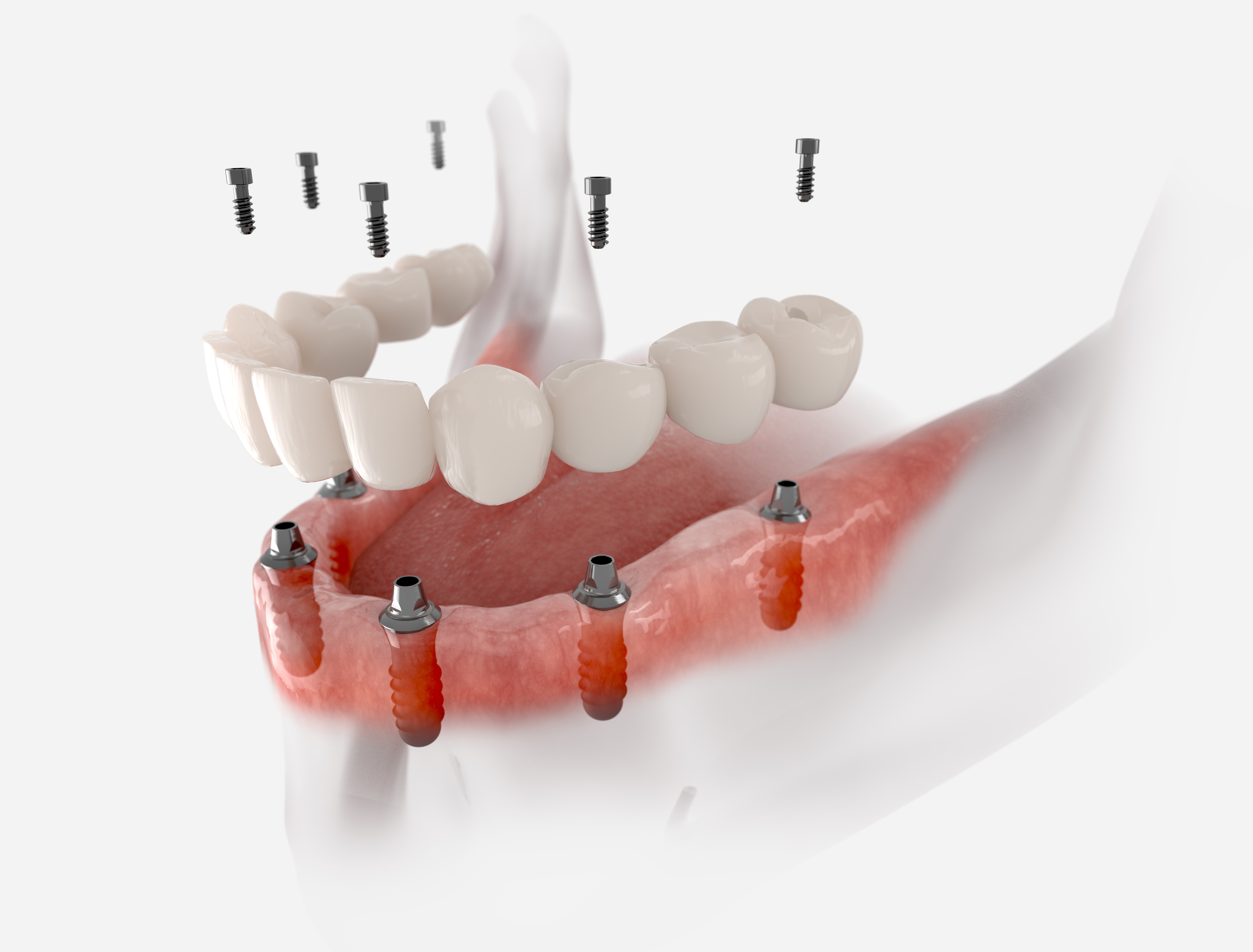 Implant-supported dentures