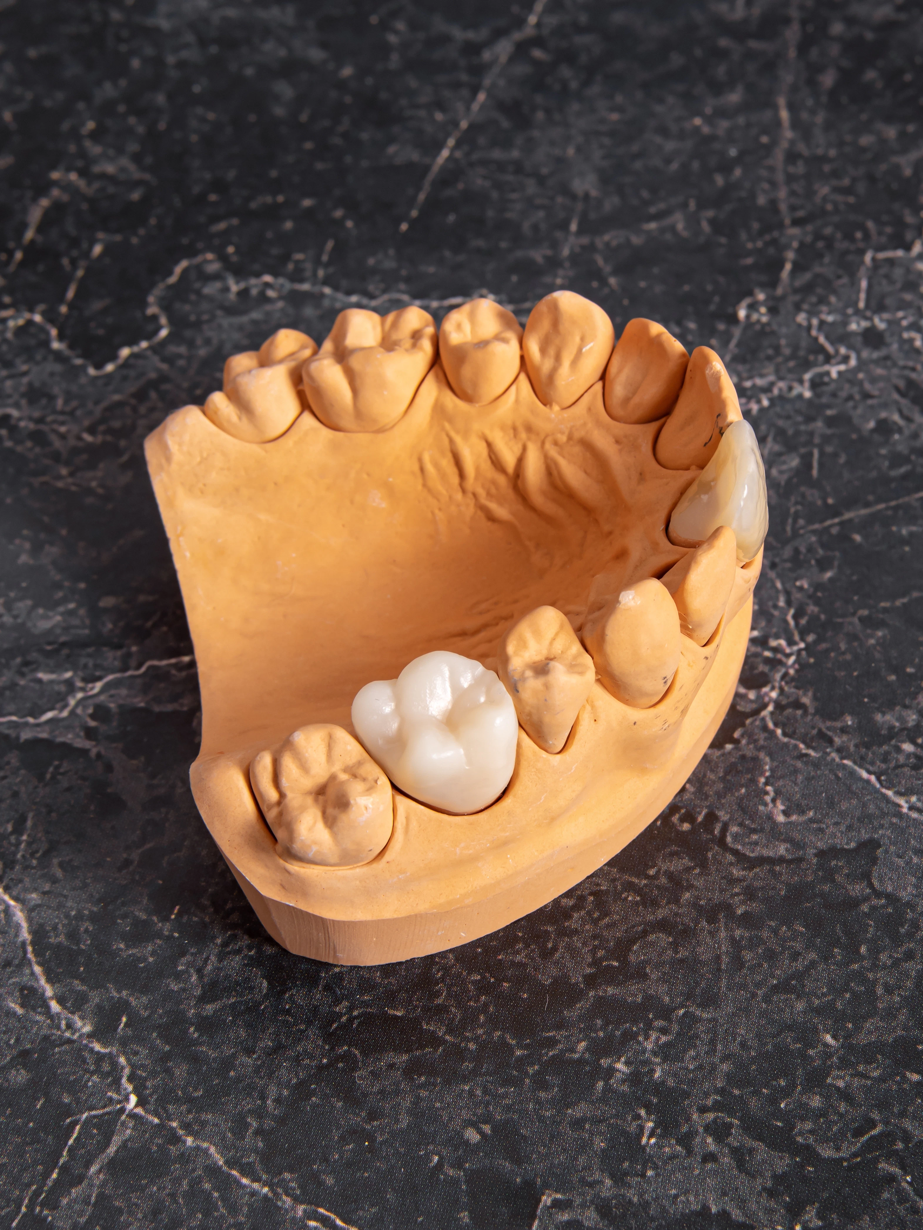 dental crowns on model arch