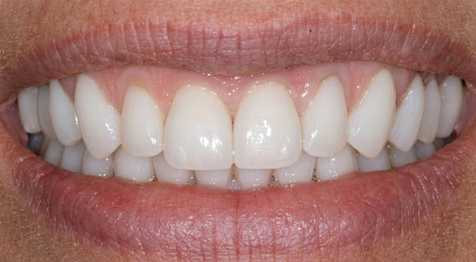 Real patient photo after veneers
