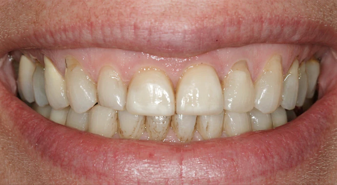 Real patient photo before veneers