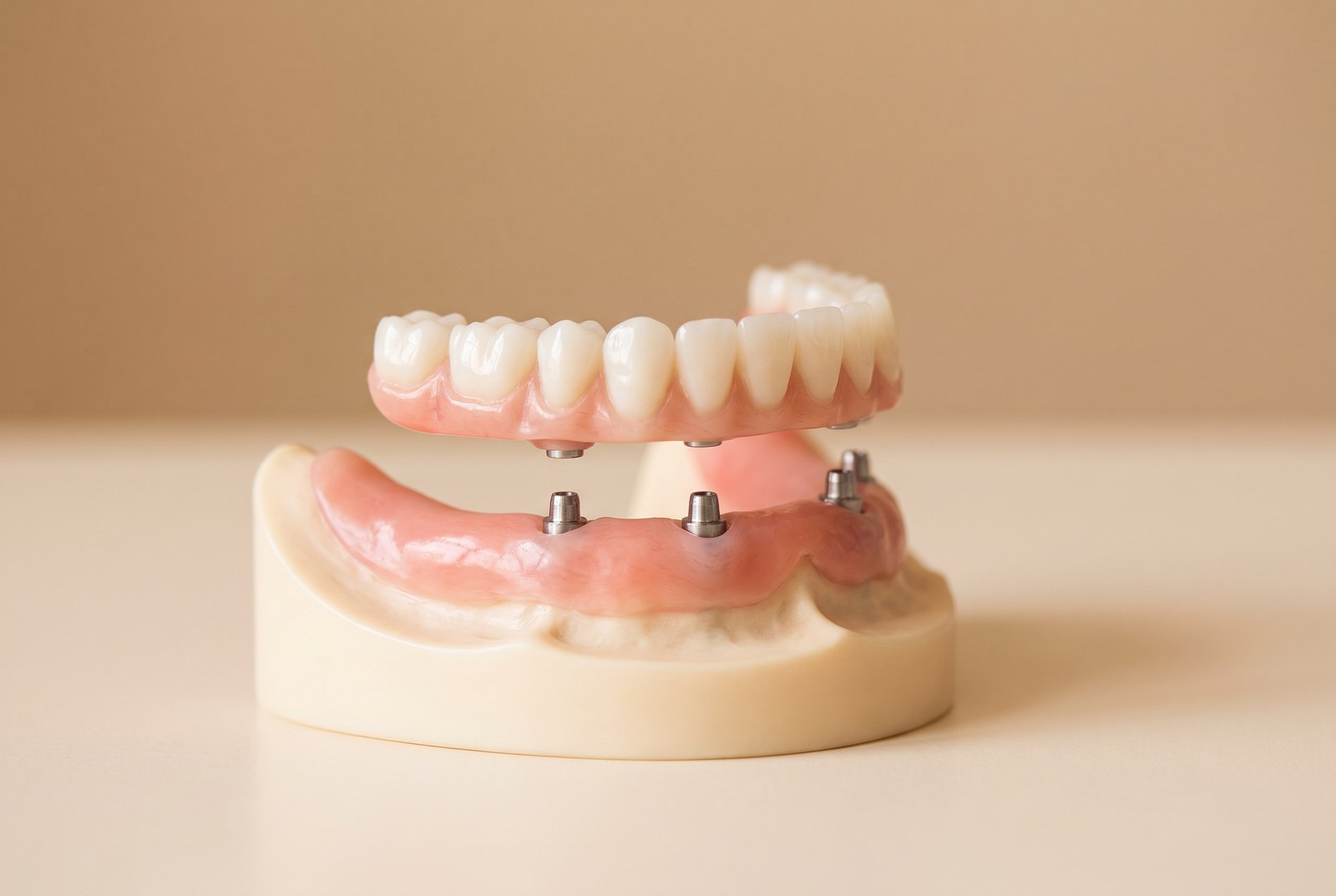 Implant-supported dentures