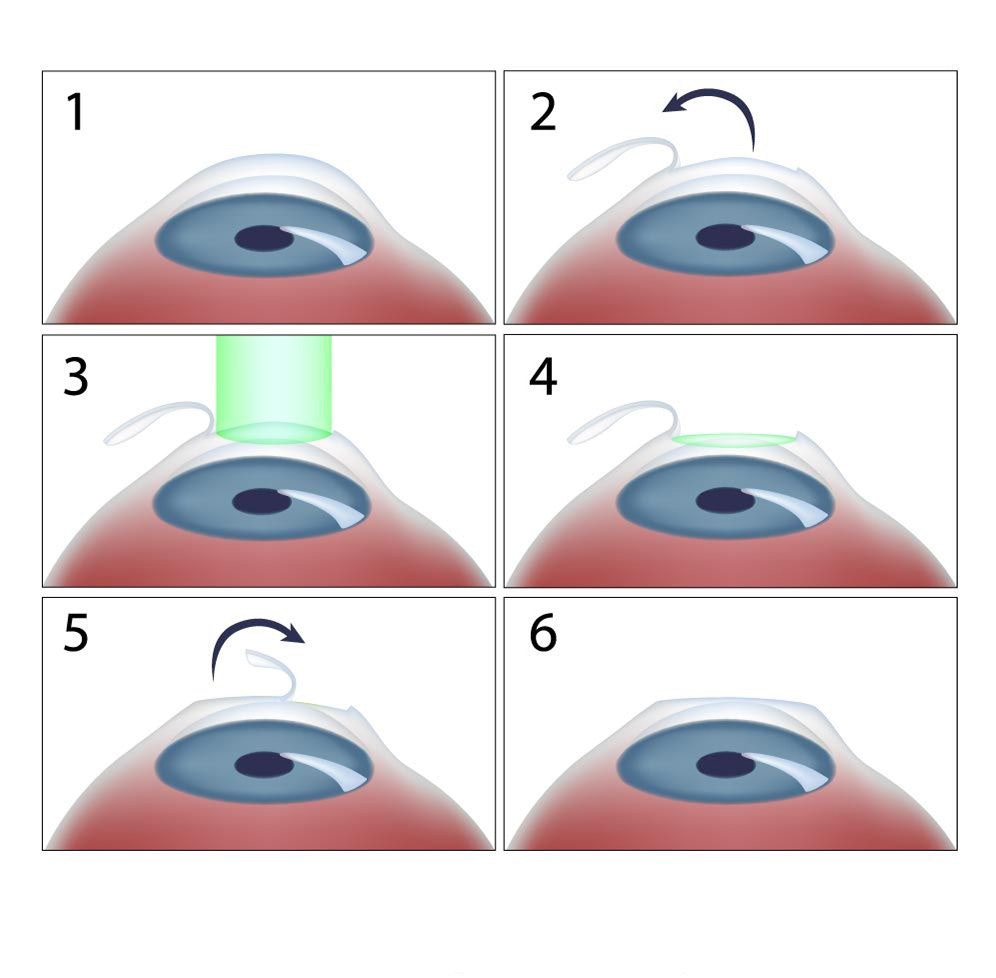illustration of LASIK process