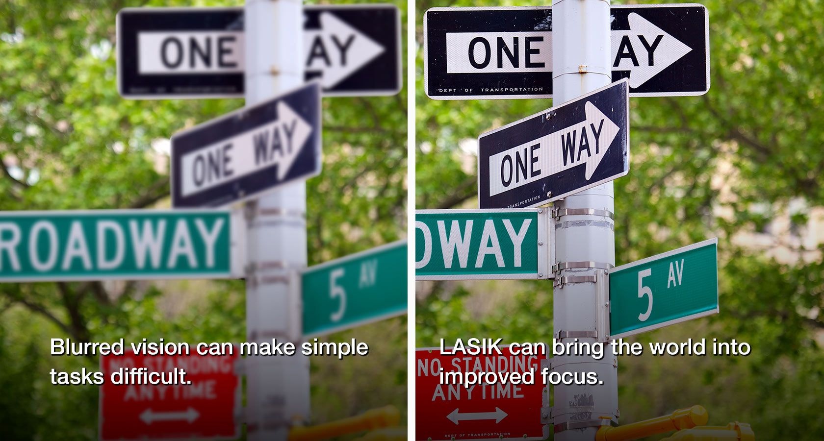 Before and after LASIK