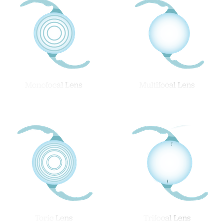 A monofocal, multifocal, toric, and trifocal IOL