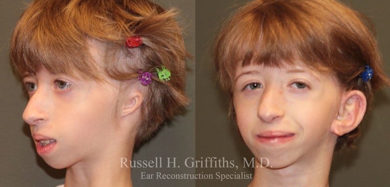Before and after one stage bilateral microtia ear reconstruction surgery