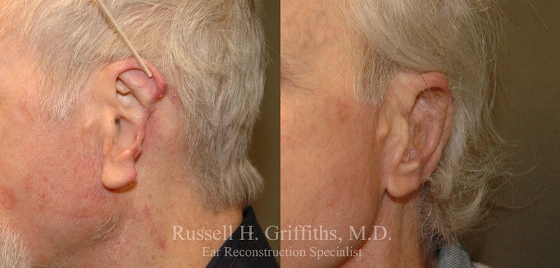 Before and after cancer reconstructive ear surgery