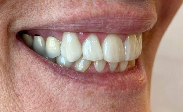 After Veneers