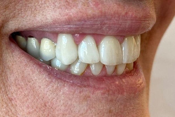 After Veneers