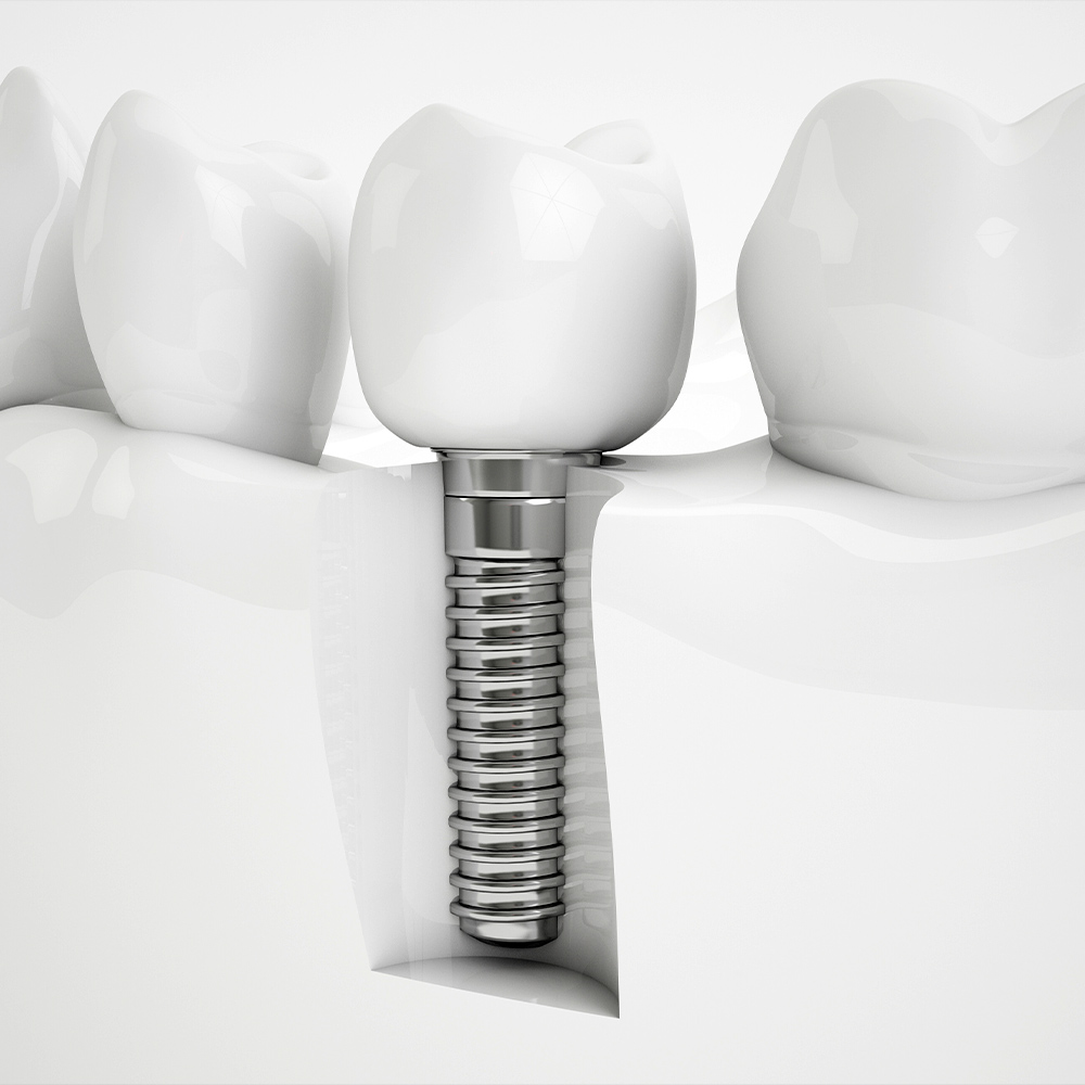 Dental Implant Model