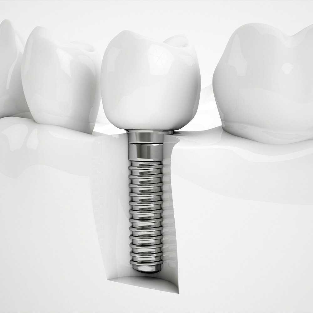 Dental Implant Model