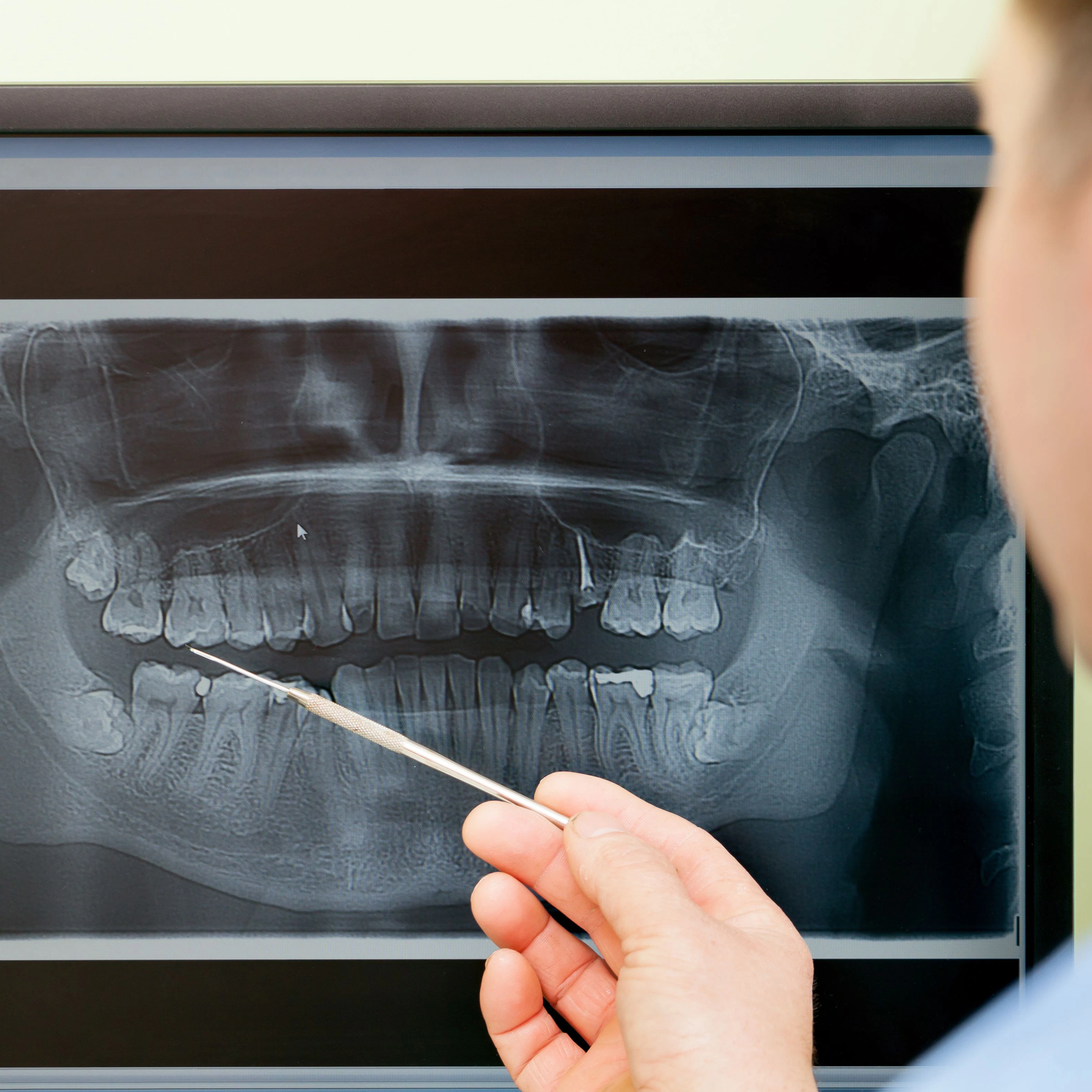 Gloved hand with pen pointing to dental x-ray