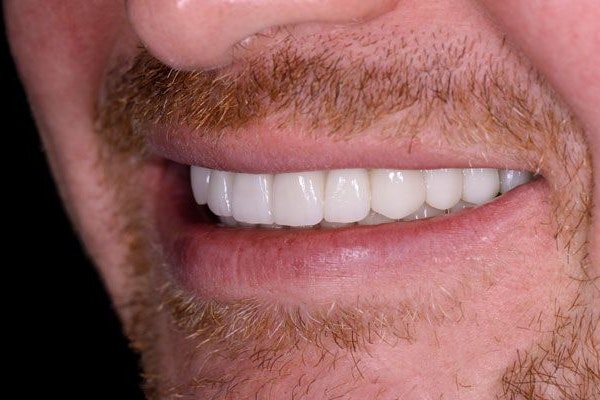 After Dental Implant