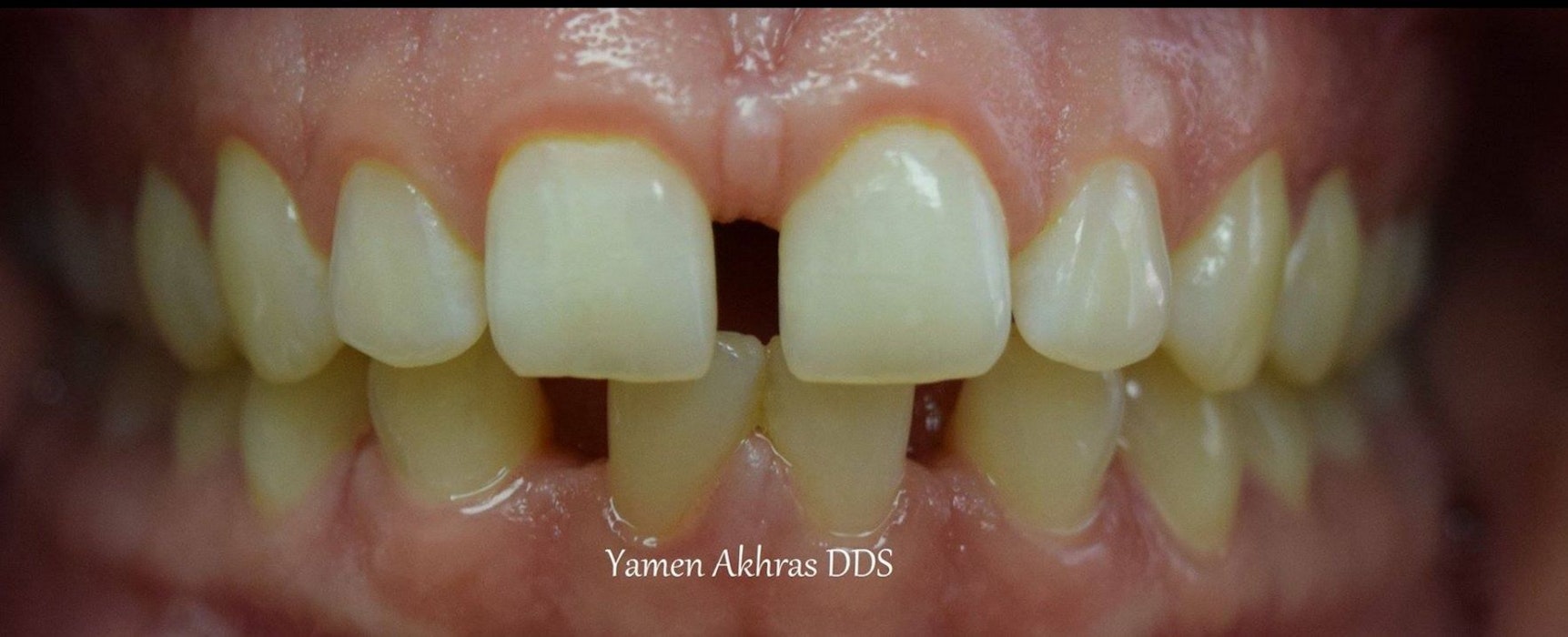 Dr. Shammaa's patient Before Braces & Dental Bonding