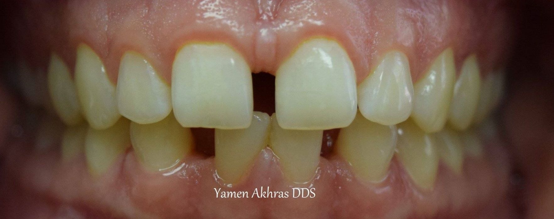 Dr. Shammaa's patient Before Braces & Dental Bonding