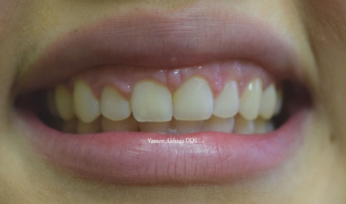 Dr. Shammaa's patient After Braces & Dental Bonding