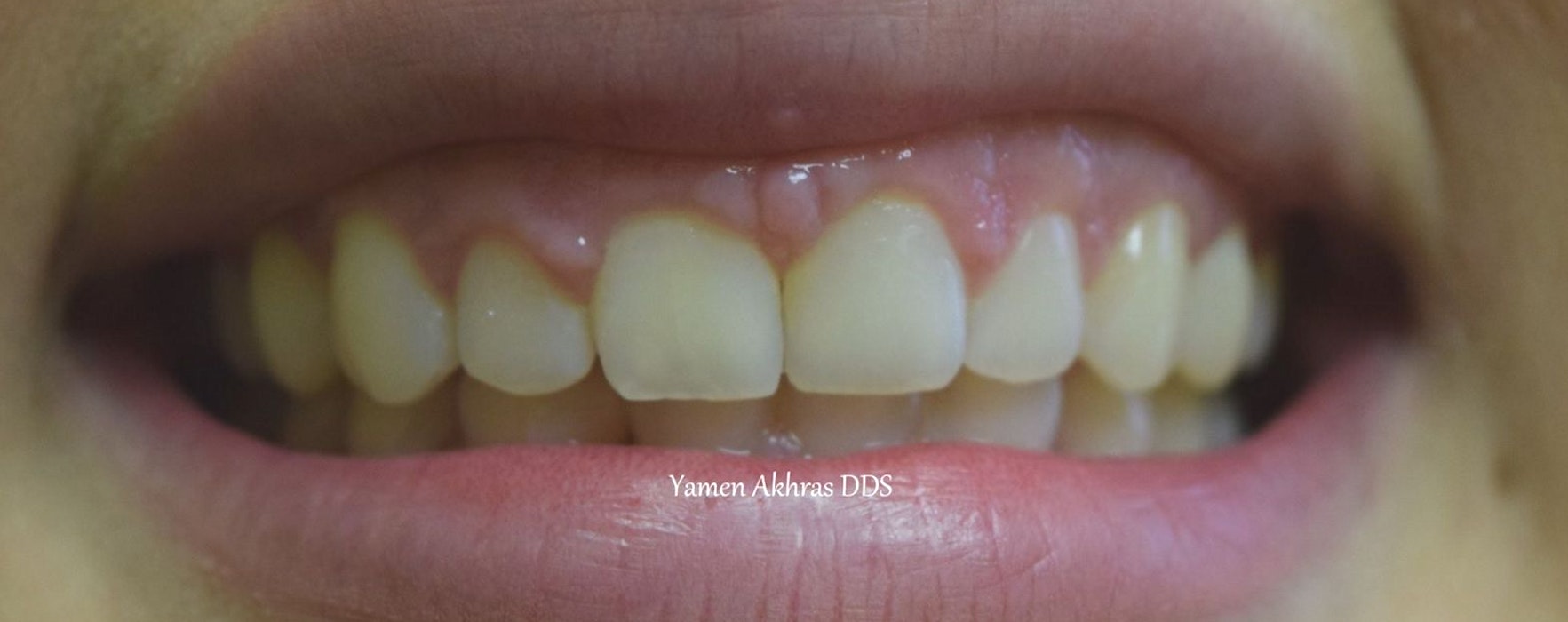 Dr. Shammaa's patient After Braces & Dental Bonding