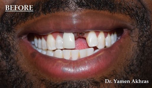 Dr. Yamen Akhras's patient missing a front tooth