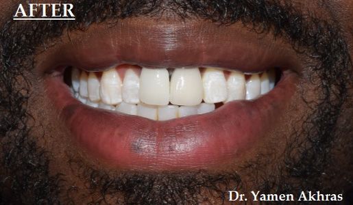 Dr. Yamen Akhras's patient with an implant-supported crown and beautiful smile