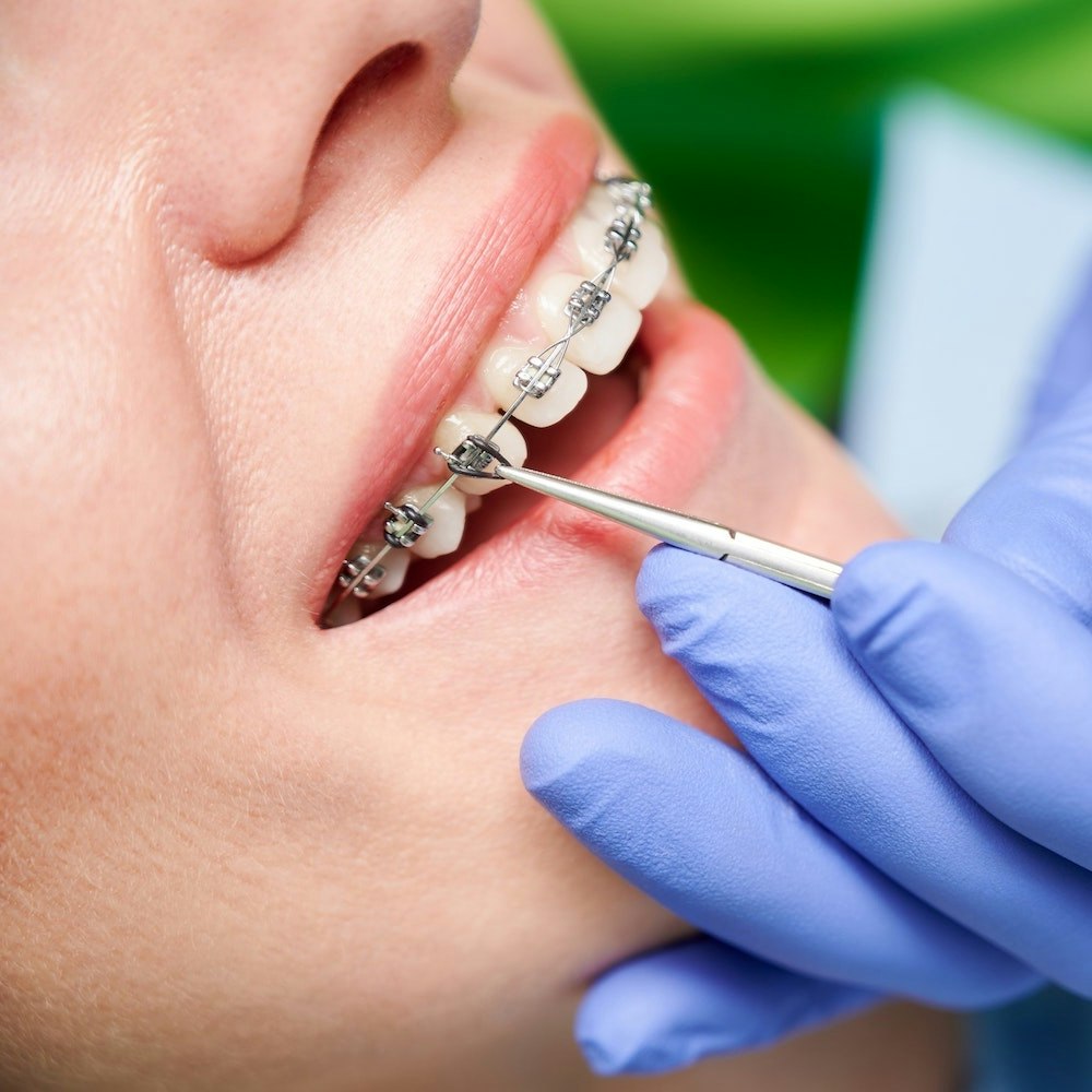 Patient receiving braces