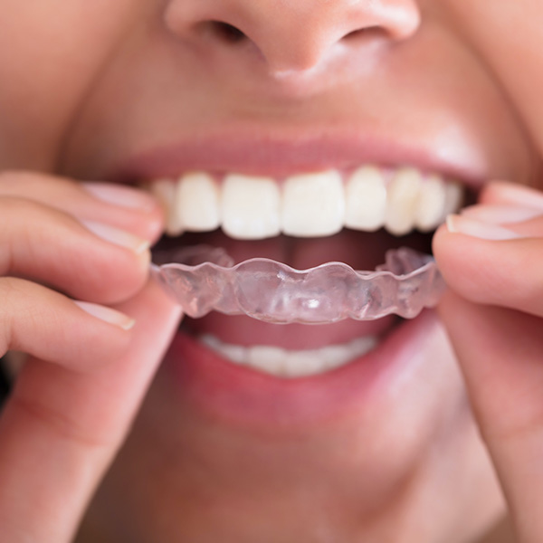 Woman putting in Invisalign Tray
