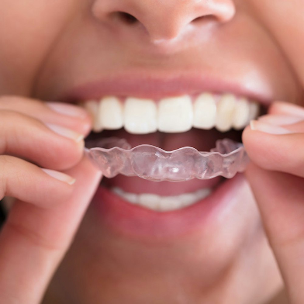 Woman putting in Invisalign Tray