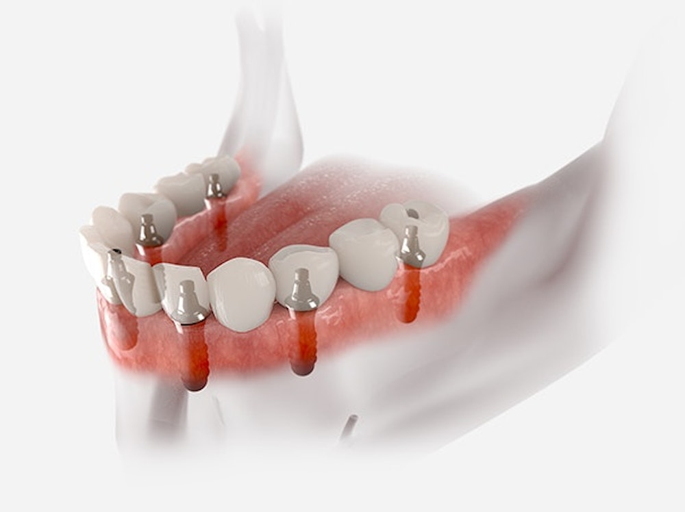 all on 4 dental implants