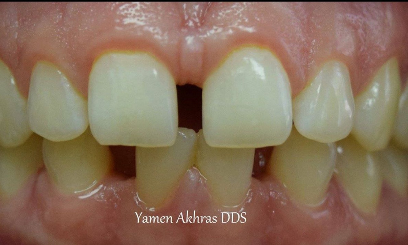 Dr. Yamen Akhras's patient before braces and bonding