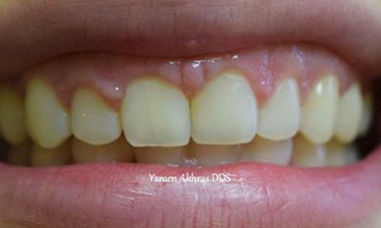 Dr. Yamen Akhras's patient before braces and bonding
