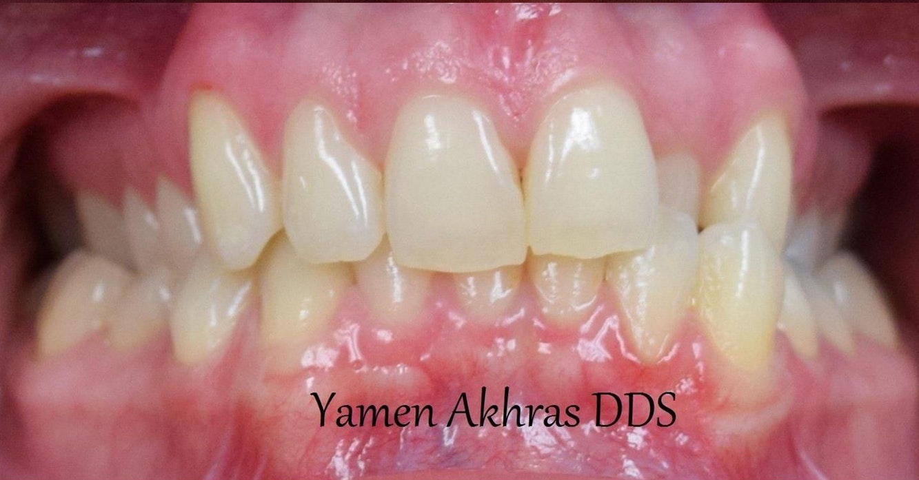 Dr. Yamen Akhras's patient before braces