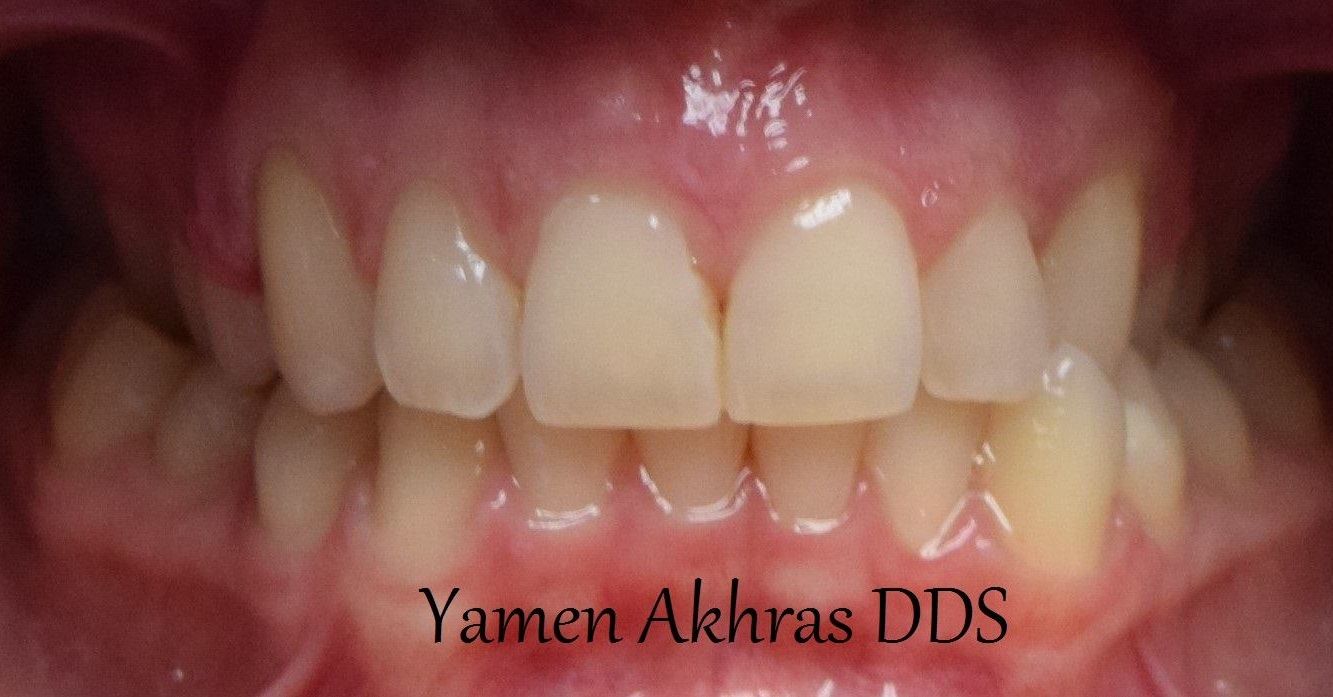Dr. Yamen Akhras's patient after braces