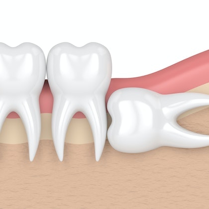 Horizontal Impaction of wisdom teeth