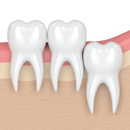 Vertical Impaction of wisdom teeth