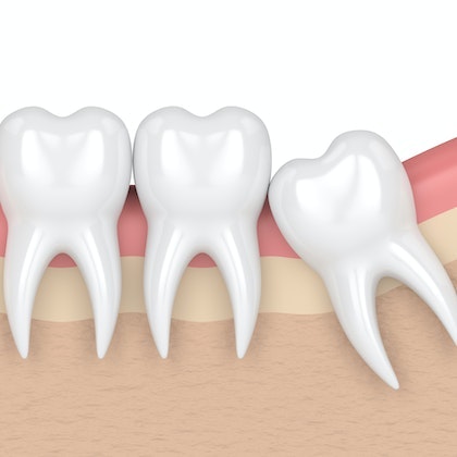 angled Impactions of wisdom teeth
