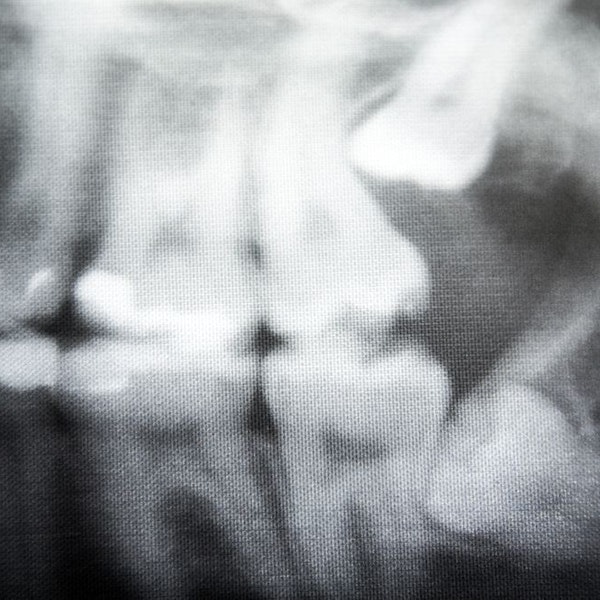 X-ray of wisdom teeth