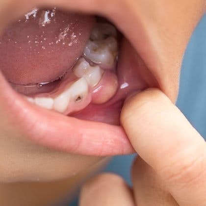 Patient in need of wisdom tooth extraction pulling down lip to show crowded teeth and cavity