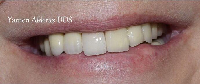 Patient 3 after dental implants