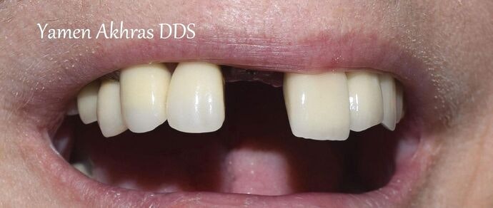 Patient 3 before dental implants