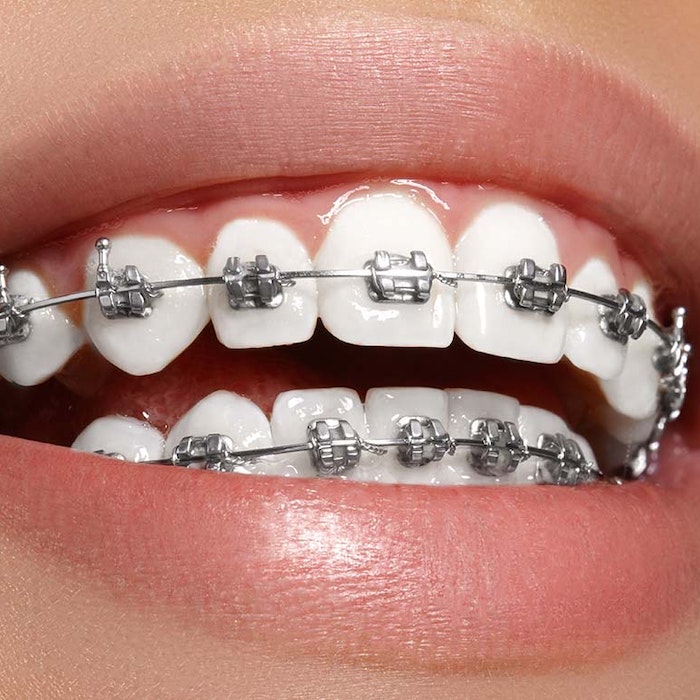 traditional braces
