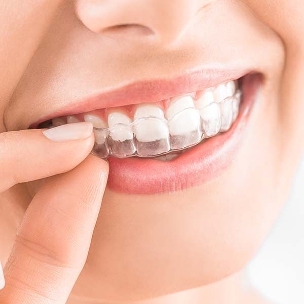 woman inserting invisalign tray