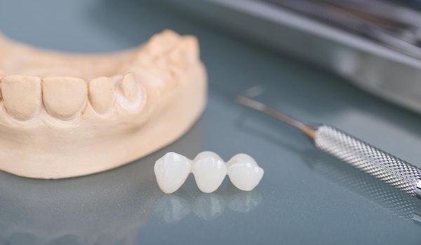 Model of teeth and a dental bridge
