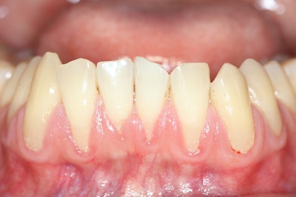 heavily receded gumline as a result of gum disease