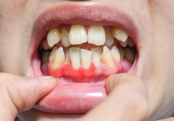 Tooth Red Gum Disease Orland Park, IL - Periodontal Disease - Premier Dental ...