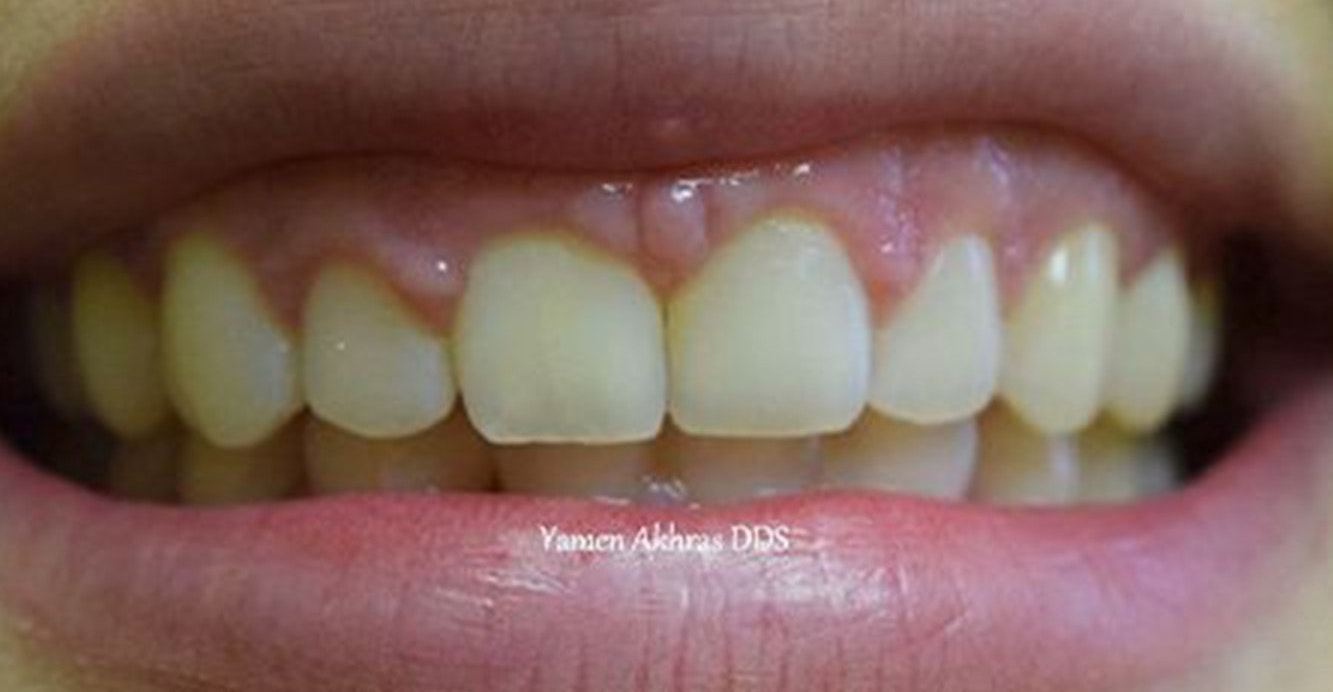 Orthodontist Amer Shammaa's patient after braces