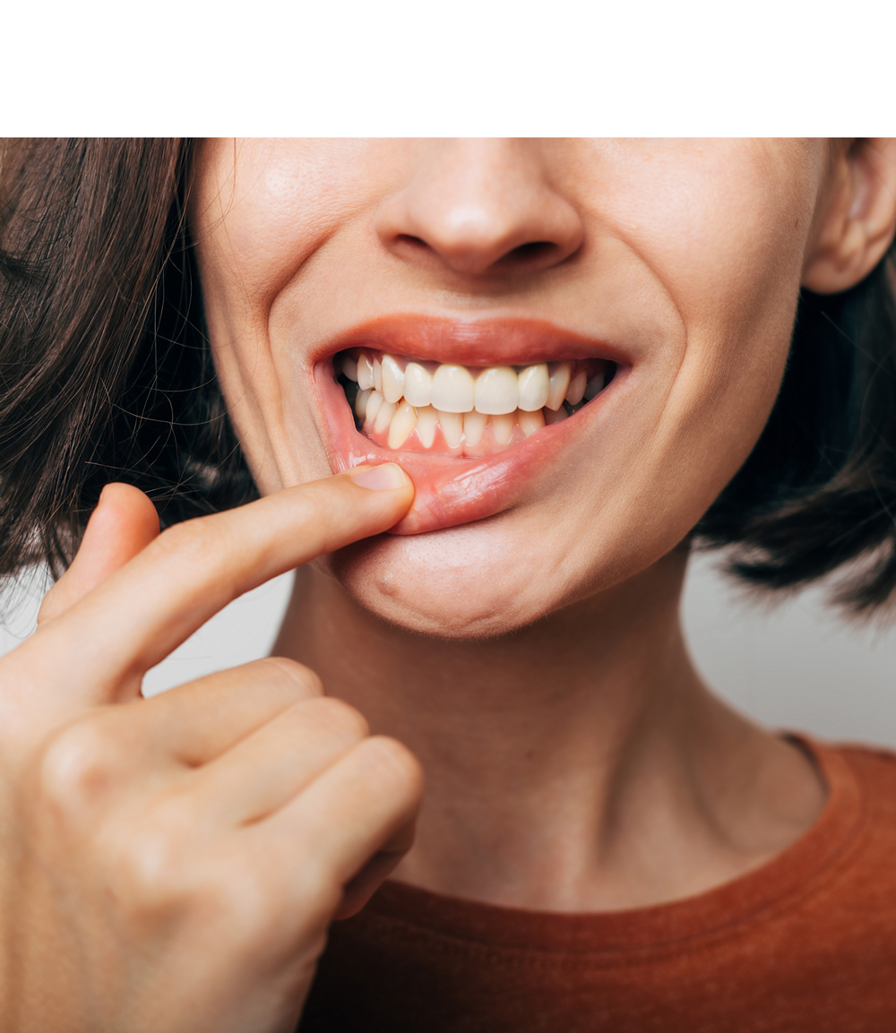 Woman pulling down lip to show gums