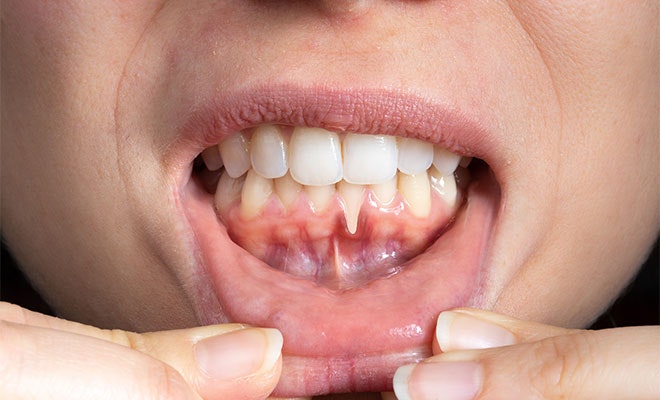 Person showing gum recession