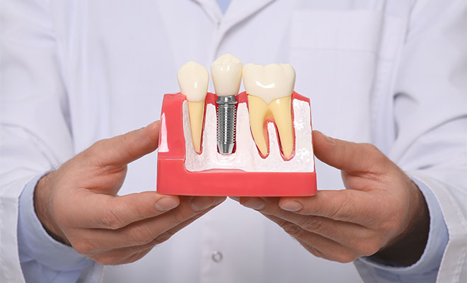Model of a dental implant