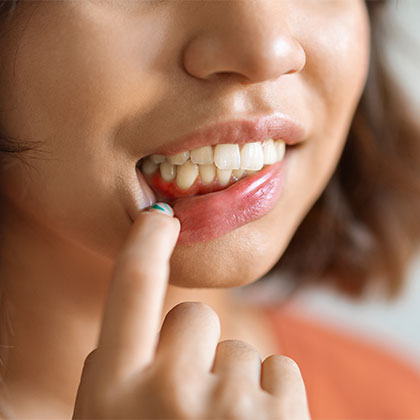 red puffy gums suffering from gum disease