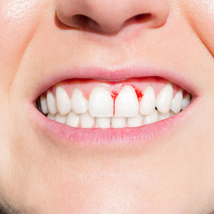 bleeding gums suffering from gum disease