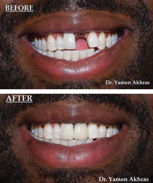 Before and after receiving an implant-supported crown